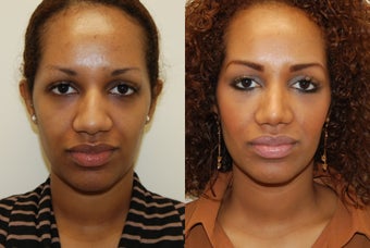 African Rhinoplasty Surgery. 1 month post-op before 754365