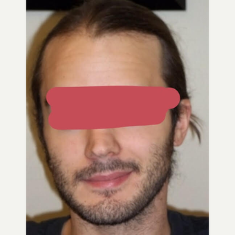 25-34 year old man treated with ARTAS Robotic Hair Transplant before 3689432