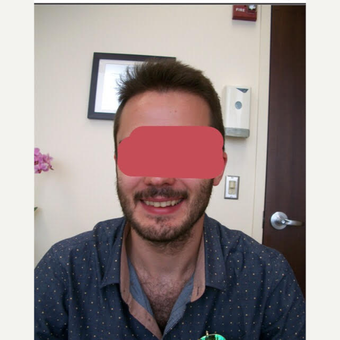25-34 year old man treated with ARTAS Robotic Hair Transplant after 3689432