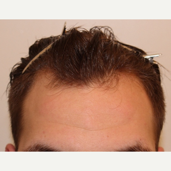 Hairline of 25-34 year-old man treated with FUE Hair Transplant before 3360898