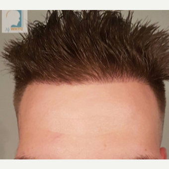 Hairline of 25-34 year-old man treated with FUE Hair Transplant after 3360898