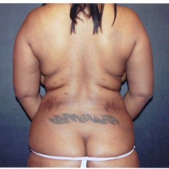 35-44 year old woman treated with Liposuction Revision before 2663479