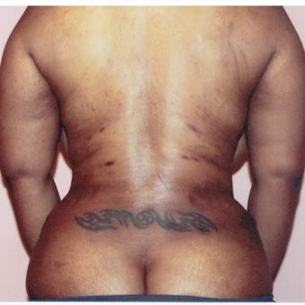 35-44 year old woman treated with Liposuction Revision after 2663479