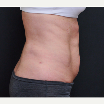 55-64 year old woman treated with Laser Liposuction after 3781088