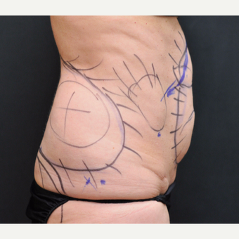 55-64 year old woman treated with Laser Liposuction before 3781088