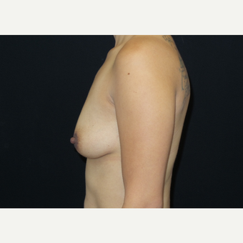 25-34 year old woman treated with Breast Lift with Implants before 3305910