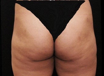 Liposuction Lateral Thigh PAL after 197948