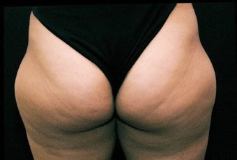 Liposuction Lateral Thigh PAL before 197948