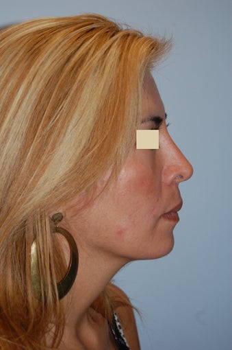 Revision Rhinoplasty after 166041