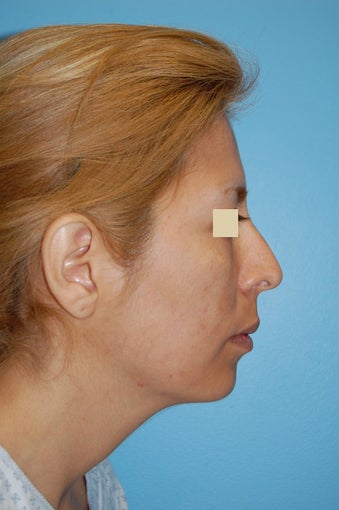 Revision Rhinoplasty before 166041