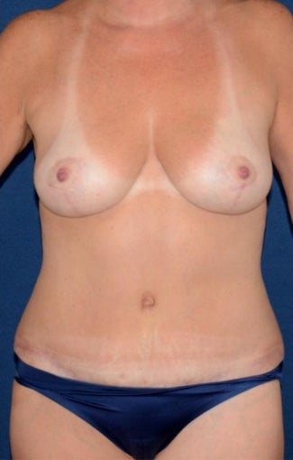 45-54 year old woman treated with Mommy Makeover (breast lift, tummy tuck, liposuction) after 1996220