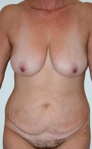 45-54 year old woman treated with Mommy Makeover (breast lift, tummy tuck, liposuction) before 1996220