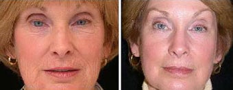 Before and after Traditional CO2 Laser Resurfacing for Wrinkle Removal before 1094089