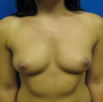 Breast Augmentation, Breast Implants before 1114928