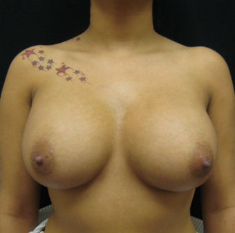 Breast Augmentation, Breast Implants after 1114928