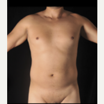 25-34 year old man treated with Liposculpture before 3355147
