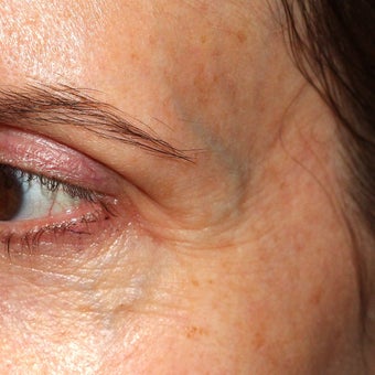 53 year old woman treated for blue veins around eyes and temples 1956282