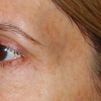 53 year old woman treated for blue veins around eyes and temples 1956282