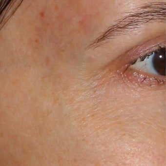 53 year old woman treated for blue veins around eyes and temples after 1956282