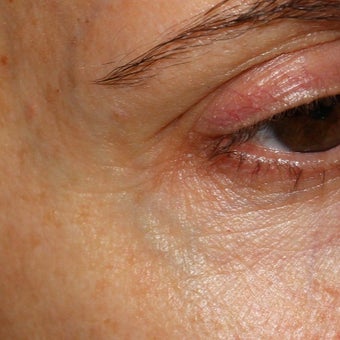 53 year old woman treated for blue veins around eyes and temples before 1956282