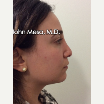 25-34 year old woman treated with Buccal Fat Removal before 3769134