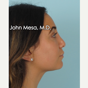 25-34 year old woman treated with Buccal Fat Removal after 3769134
