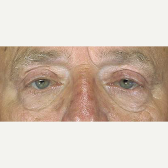 65-74 year old man treated with Eyelid Surgery after 3251967