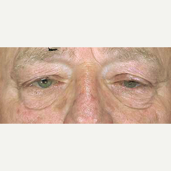 65-74 year old man treated with Eyelid Surgery before 3251967