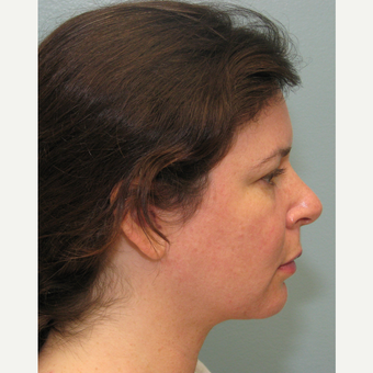 35-44 year old woman treated with Smart Lipo after 3143216