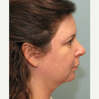 35-44 year old woman treated with Smart Lipo before 3143216