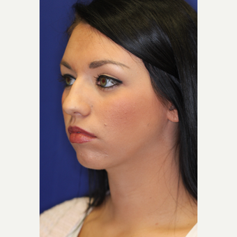 25-34 year old woman treated with Chin Liposuction after 3260035
