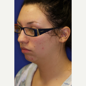 25-34 year old woman treated with Chin Liposuction before 3260035
