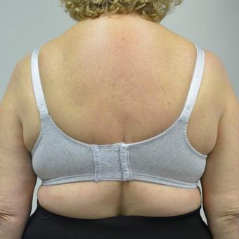 65-74 year old woman treated with Upper Body Lift/ Bra Line Back Lift after 3850401