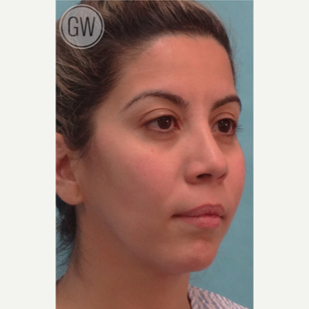 25-34 year old woman treated with Nose Surgery before 3477976
