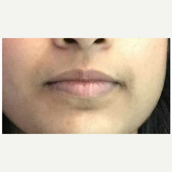 25-34 year old woman treated with Injectable Fillers before 3219663