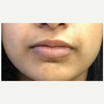25-34 year old woman treated with Injectable Fillers after 3219663