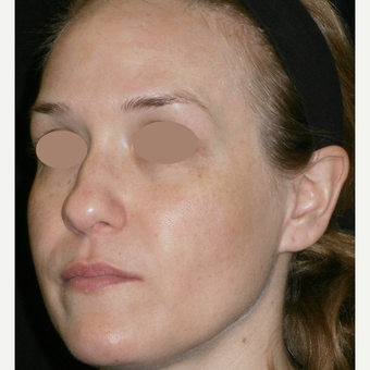 35-44 year old woman treated with Chemical Peel before 3147124