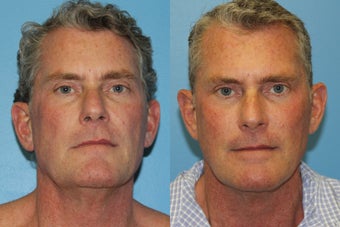 Exilis face male before 938952
