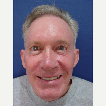 45-54 year old man treated with Laser Treatment after 3603857