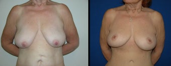 53 Year Old Woman - Breast Lift with Augmentation before 1094099