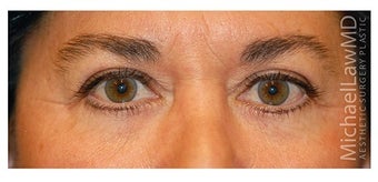Eye Bag Surgery after 1256422