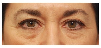 Eye Bag Surgery before 1256422