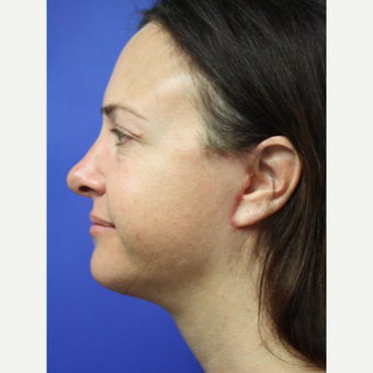 35-44 year old woman treated with Facelift after 3405549