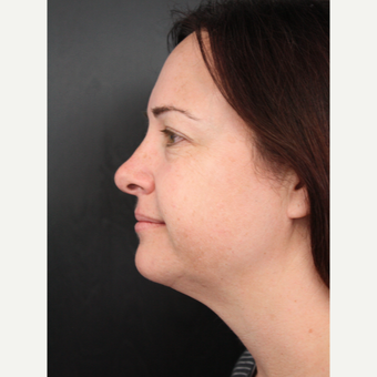 35-44 year old woman treated with Facelift before 3405549