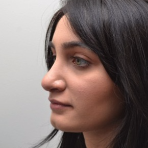 18-24 year old woman treated with Rhinoplasty after 3747707