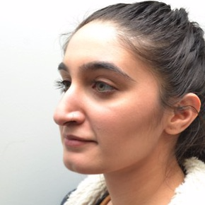 18-24 year old woman treated with Rhinoplasty before 3747707