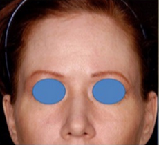 25-34 year old woman treated with Forehead Reduction before 1901667
