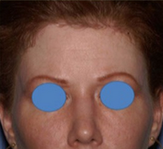 25-34 year old woman treated with Forehead Reduction after 1901667