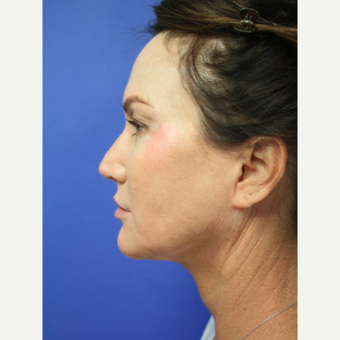 45-54 year old woman treated with Facelift Revision after 3405327