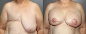 Latissimus Breast Reconstruction before 1301081